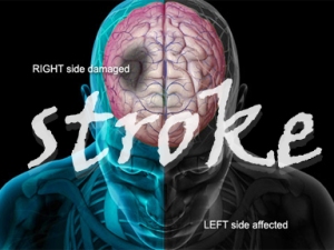 stroke-adv1